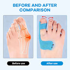 Bunion Correction Muscle Tape🦶 The Easier Way To Support & Protect Your Bunion Every Day