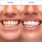 Hismile V34 Whitening Strips - Purple Teeth Whitening & Colour Correction